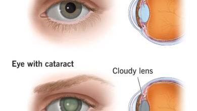 Common Eye Conditions समझना, इसके कारण, लक्षण और उपचार के विकल्प को भी जानिये