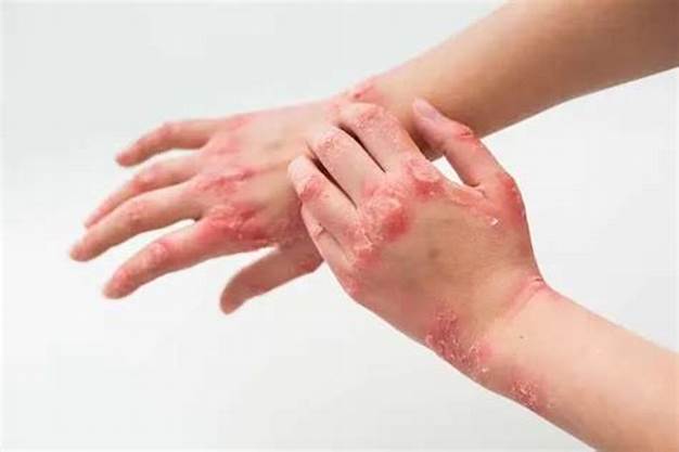 Winter Allergies: प्रारंभिक लक्षण, उपचार, कारण, रोकथाम के बारे में जानिये