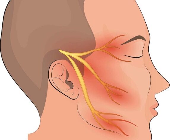 Trigeminal Neuralgia: लक्षण, उपचार और कारण जानिये