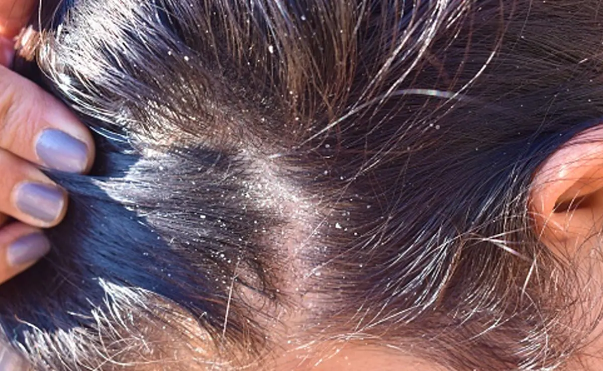 Itchy Scalp Home Remedies: सिर में बढ़ती खुजली सिर्फ डैंड्रफ नहीं इंफेक्शन की भी वजह हो सकती है; जानिए लक्षण और बचने के उपाय