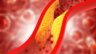 इन कारणों से खराब कोलेस्ट्रॉल नसों में जमने लगता है; अधिक triglycerides कैसे कम हो सकते हैं