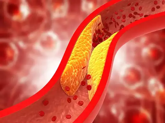 इन कारणों से खराब कोलेस्ट्रॉल नसों में जमने लगता है; अधिक triglycerides कैसे कम हो सकते हैं