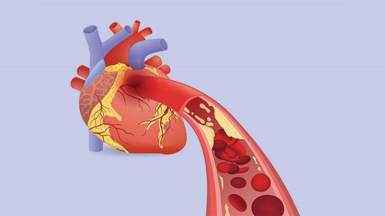 Heart Disease: एक्सपर्ट से जानें कि ब्लॉकेज में हार्ट सर्जरी की जरूरत कितने फीसदी पड़ती है