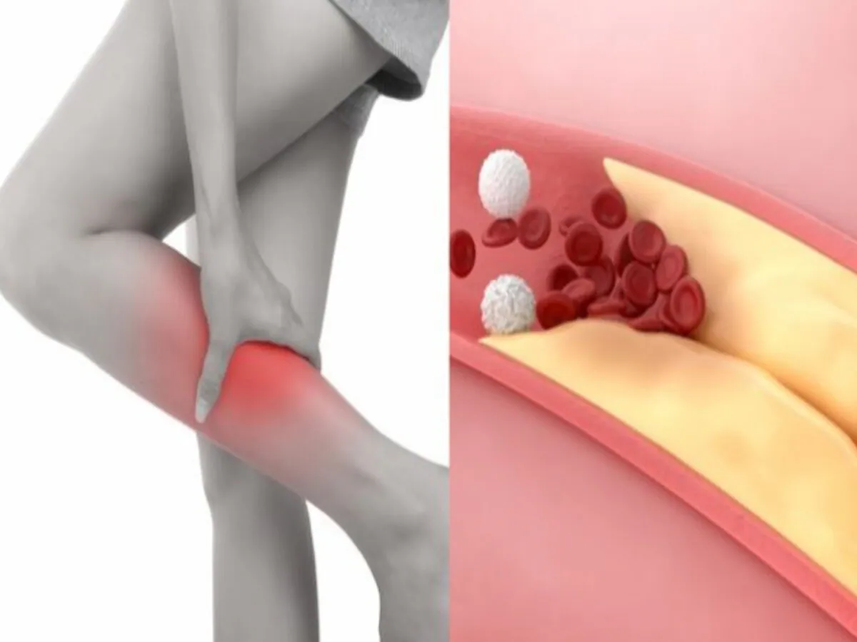 High Cholesterol Symptoms: वॉक करते समय शरीर में दिखने वाले ये लक्षण बताते हैं कि आपके शरीर में खराब कोलेस्ट्रॉल की मात्रा बढ़ी है