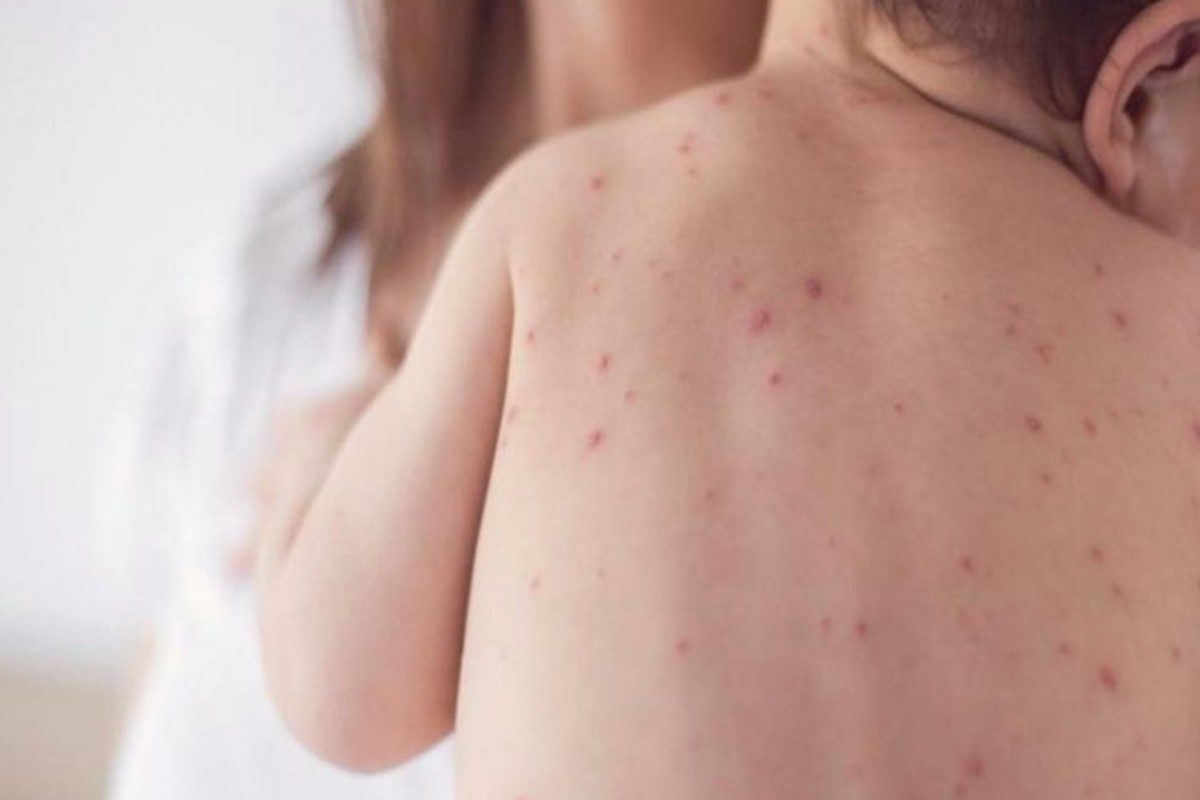 Measles Symptoms: ये खतरनाक बीमारी, जिसका वायरस तेजी से फैलता है, खत्म होने के बाद अमेरिका में फिर से फैल गई, इसके लक्षणों के साथ सैकड़ों बच्चे चपेट में