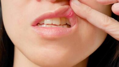 Mouth Ulcers: मुंह में बार-बार छाले निकालना किस रोग का लक्षण है? कैसे बचाव करें