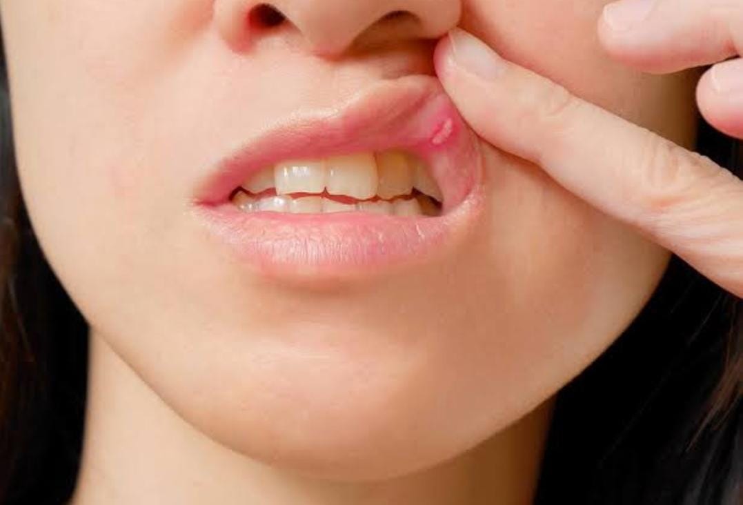 Mouth Ulcers: मुंह में बार-बार छाले निकालना किस रोग का लक्षण है? कैसे बचाव करें