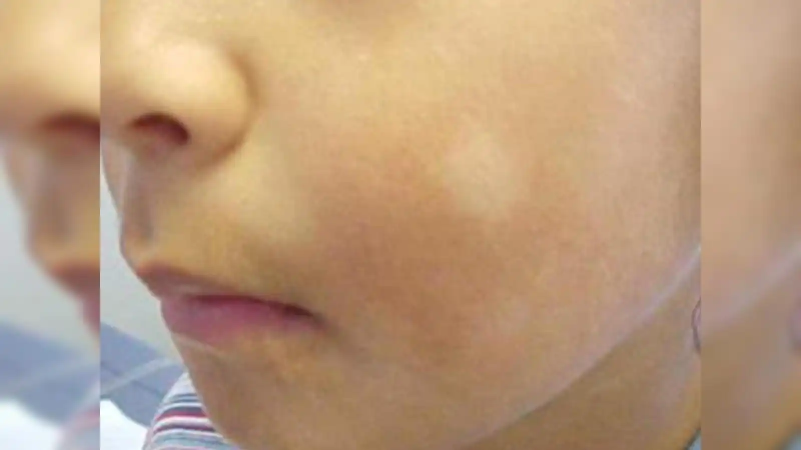White Spots On Kids Face: बच्चों के माता-पिता को चेहरे पर सफेद दाग देखकर डर लगता है. जानिए इसकी वजह और इसे कैसे ठीक करें।