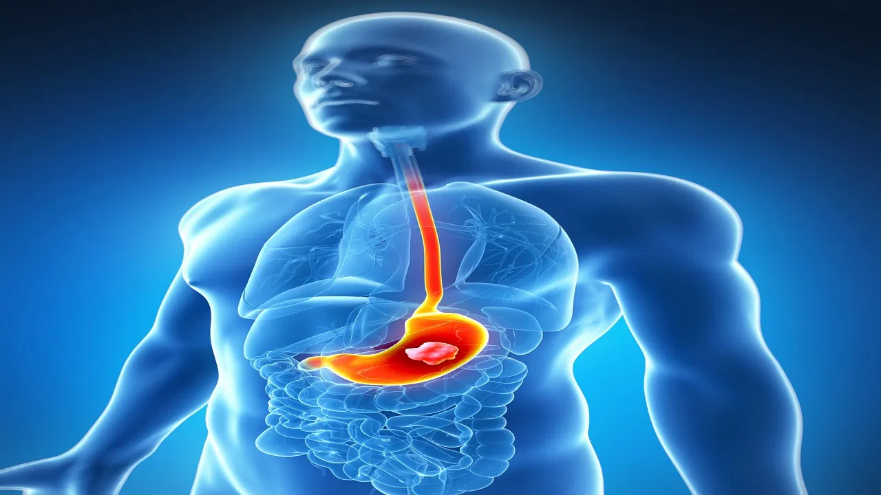 Stomach Ulcer: पेट में अल्सर के लक्षण क्या हैं और ये क्यों होते हैं?