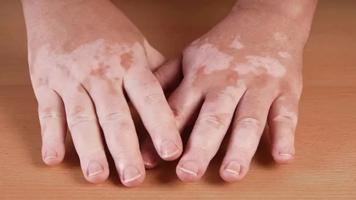 World Vitiligo Day 2025: विटिलिगो की शुरुआती पहचान? एक्सपर्ट से जानें कि समय पर इलाज से क्या बीमारी नियंत्रित हो सकती है?